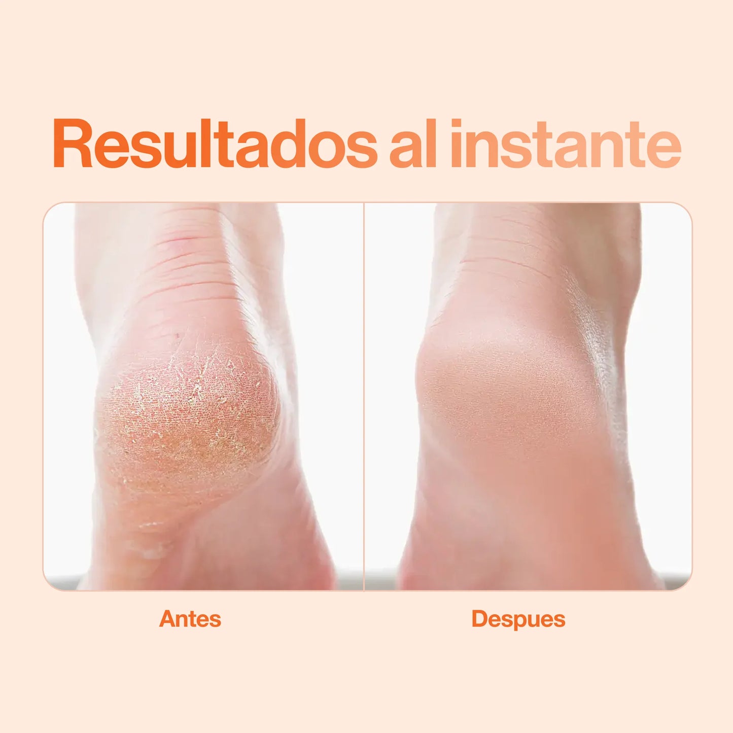 Removedor de Callos