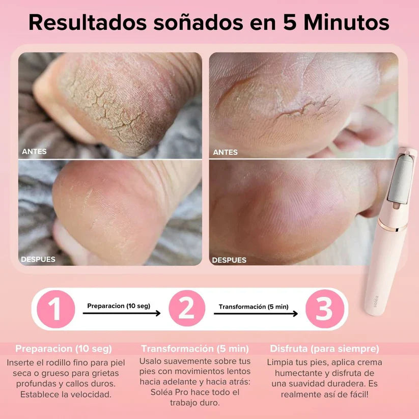 Removedor de Callos